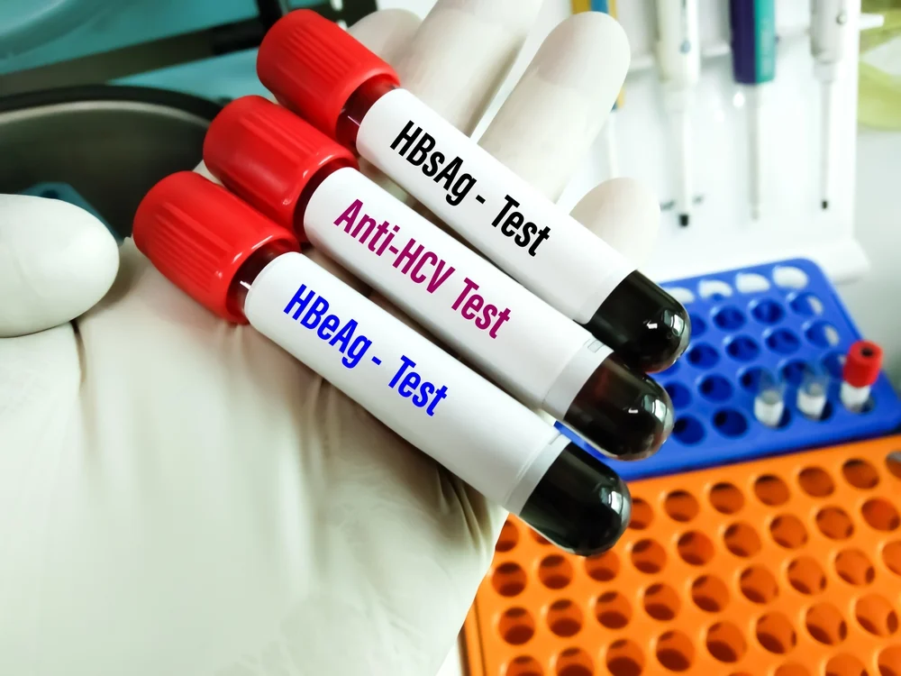 Hepatites virais: conheça os exames que podem ajudar no diagnóstico