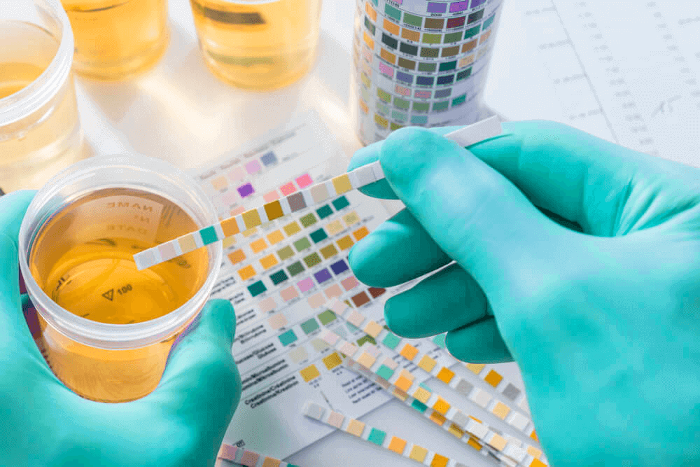 Sumário de urina: como funciona?